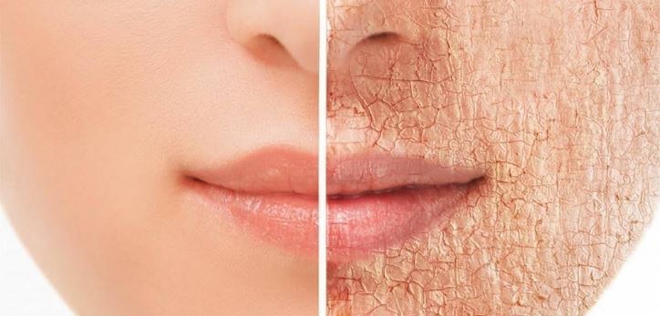 Last van een droge huid?